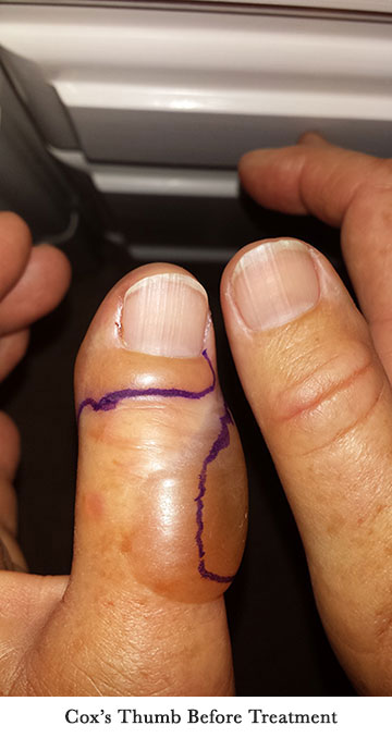Cox's Thumb Before Treatment
